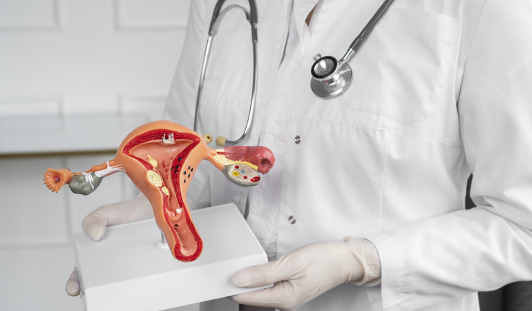 Polycystic Ovary Syndrome